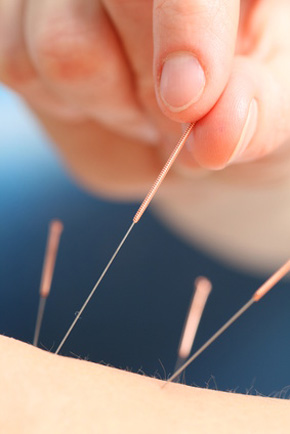 Akupunkturbehandlung