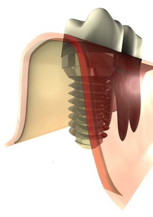 Graphik mit Zahnimplantat und echtem Zahn
